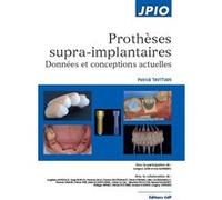 Prothèses supra-implantaires Patrick Tavitian (Auteur), Olivier Hüe (Auteur), George A. Zarb (Auteur), Iven Klineberg (Auteur)