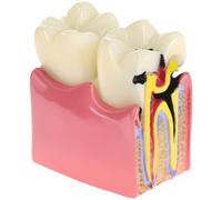 QWORK Modèle éducatif pour caries dentaires, section transversale élargie 6x, matériau en résine, pour l'éducation anatomique et l'enseignement de la santé dentaire