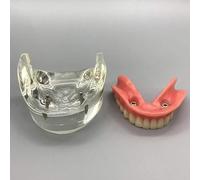 RAYACO Modèle Dentaire - Implant Dentaire Modèle - Prothèse Dentaire inférieure mandibulaire 2 implants Démonstration pour l'enseignement et l'étude