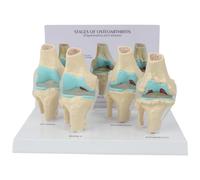 Reinscer Genoux - Modèle anatomique d'arthrose avec carte à clé pédagogique - Modèle de genou à 4 niveaux - Outil pédagogique orthopédique