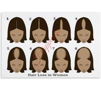 REIUAFWYGV Hair Loss Progression in Women Poster Reference | Great visual aid for consultations and patient education sessions(Framed,16x24inch(40x60cm))
