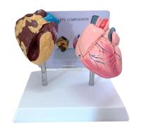 REPESSCTJ Modèle comparaison du cœur humain fumeur et du cœur sain | Modèle anatomique précis pour les organes humains, pour l'enseignement, la cardiologie et l'exposition éducative sur le tabac