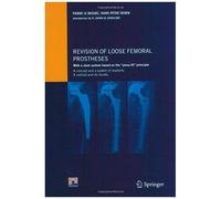Revision Of Loose Femoral Prostheses With A Stem System Based On The Press-Fit Principle