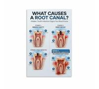 Root Canal Guide Poster Tooth Decay Wall Art Clinic Decor | Dentist Office Print Promotes Preventative Care and Early Intervention(Framed,12x18inch(30x45cm))