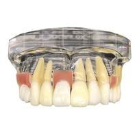 Ryanong Modèle de typodont dentaire pour restauration d'implant, modèle de dents de démonstration d'analyse d'implant maxillaire avec dents amovibles et gomme molle pour l'enseignement. ?