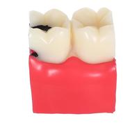 SAFIGLE Modèle Pédagogique d'Anatomie pour Dentistes Modèle de Carie Agrandi 6X Outil Éducatif Comparatif des Dents Cariées Simulation Réaliste pour Formation et Démonstration en