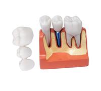 Sarini Modèle de dent buccale, modèle d'implant Dentaire avec Couronne et Pont Amovibles, adapté à la démonstration en Classe et à la Formation des étudiants en médecine Dentaire