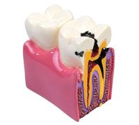 Sarini Modèle Dentaire, modèle d'étude de comparaison des Caries, modèle d'enseignement de l'anatomie Dentaire pour dentistes, adapté aux dentistes, aux Patients, aux Enseignants et aux étudiants
