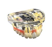SdaryWare Modèle de Dents implantaires - Modèle de Formation aux implants dentaires - avec gencives Souples, pour l'enseignement des Sciences, Outil de Communication médecin-Patient,A