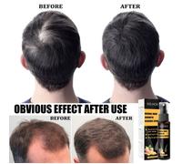 Sérum anti-chute à base de plantes Densifier le cuir chevelu Prévention de la chute des cheveux