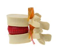 Squelette anatomique humaine, colonne vertébrale, hernie discale, modèle pédagogique, augmentation des lésions de la colonne vertébrale, outil médical, modèles d'accessoires, kilbane