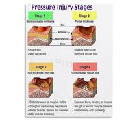 SSOPTMCB Educational Canvas Painting Pressure Ulcer Staging Guide Chart for Clinical Setting(Framed,08x12inch(20x30cm))
