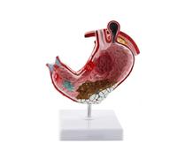 Supkancl Humain À Anatomie d'estomac pathologique Modèle de démonstration des Maladies l'estomac Anatomie