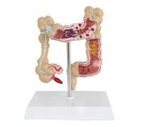 Supkancl Modèle de maladie colorectale Humaine Anatomie pathologique du côlon médicament intestinal Enseignant Le modèle Anatomique