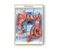 Supkancl Tableau de pathologie Anatomie Maladies Affiches et Impressions Toile Art Peinture Mur Photos for Salon décoration décor à la Maison(M,50X70cm No Frame)