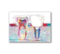 TANYANG Toile D'Implant Dentaire, Peinture Sur Toile Imprimée, Tableau D'Art Mural De Dentiste, Affiche De Médecine Hygiéniste, Décoration De Clinique Aquarelle 50X70Cm Sans Cadre
