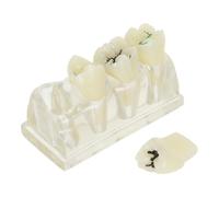 Toyvian Modèle Éducatif de Dents Caries 4 Fois Agrandi en Abs pour Enseignement de L'hygiène Bucco-dentaire en t Formation des Étudiants Dentaires