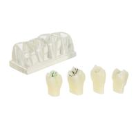 Toyvian Modèle Éducatif de Dents Typodont en Abs pour Démonstration Orale Solide, Outil Pédagogique Carie 4 Fois, pour Usage en t Communication