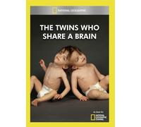 Twins Who Share a Brain