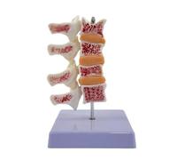TWTCZOZ Modèle Anatomique Colonne Vertébrale Lésions Osseuses sur Socle Stable pour Enseignement Médical Démonstration Scolaire.