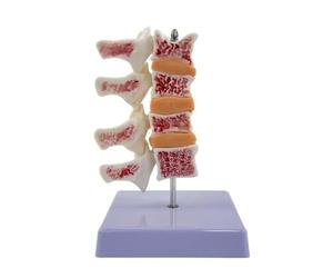 TWTCZOZ Modèle Anatomique Colonne Vertébrale Lésions Osseuses sur Socle Stable pour Enseignement Médical Démonstration Scolaire.
