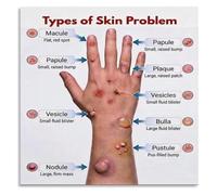 Types of Skin Lesions Poster Dermatology Reference Chart | Identify common skin conditions with this detailed educational visual.(Framed,16x24inch(40x60cm))
