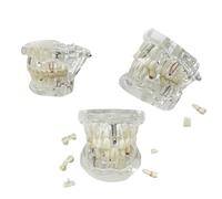 UIGJIOG Implant Dentaire Transparent Modèle de Dentiste Maladie Standard Pathologie Dentaire Amovible Modèle d'enseignement Maladie Transparente Modèle de Dents