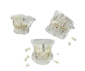 UIGJIOG Implant Dentaire Transparent Modèle de Dentiste Maladie Standard Pathologie Dentaire Amovible Modèle d'enseignement Maladie Transparente Modèle de Dents