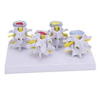 UIGJIOG Modèle de la Colonne vertébrate à 4 étapes de la Colonne Lombaire de la Colonne vertébrale, Une Colonne vertébrale des vertèbres médico-lombaires de modèles normaux et pathologiques