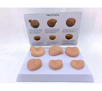 UIGJIOG Modèle De Lésion De La Prostate Six Modèle De Contraste Normal De La Prostate Et du Cancer De La Prostate Modèle Anatomique De La Prostate pour l'enseignement De L'affichage De L'étude