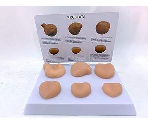 UIGJIOG Modèle De Lésion De La Prostate Six Modèle De Contraste Normal De La Prostate Et du Cancer De La Prostate Modèle Anatomique De La Prostate pour l'enseignement De L'affichage De L'étude