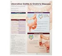 Ulcerative Colitis & Crohn's Disease Anatomical Chart Laminated - [Livre en VO] Anatomical Chart Company (Auteur)