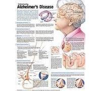 Understanding Alzheimer's Disease Anatomical Chart