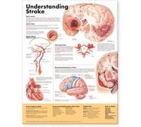 Understanding Stroke Anatomical Chart Anatomical Chart Company (Auteur)