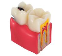 VANZACK Modèle Comparatif D'Anatomie Des Caries Dentaires En Résine : Outil Bilatéral Pour L'éducation Des Patients En Milieu Éducatif