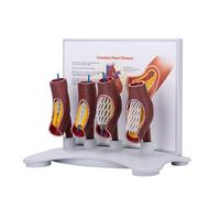 Vascular Stent Model, Human Coronary Stent Model, Anatomical,Human Vessel Enlargement Demonstration,Vascular Blockage Model