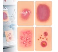 WADPP Lot de 4 Modèles d'Enseignement de la Dermatologie, Simulation de l'Infection Bactérienne de la Peau pour Cellulite, Impétigo, Folliculite, Aide Pédagogique Médicale et Soins Infirmiers