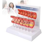 WADPP Modèle d'Athérosclérose Humaine 7PCS, Modèle Anatomique de Progression des Maladies Artérielles, Vaisseaux Sanguins Cardiovasculaires pour Enseignement Médical et Éducation des Patients