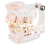 Walfront Modèle de Dents Amovibles, Transparent Dentaire Implant Disease Enseignement Étude Standard Dents Modèle Démonstration Pathologique