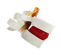 WANGCAIER Human Organ Teaching Model Model Spine Lumbar Herniation Disc Human Models Anatomical Anatomy Vertebral Teaching Intervertebral Chiropractic