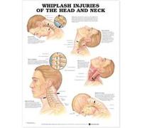 Whiplash Injuries of the Head and Neck Anatomical Chart