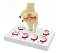 WHOOLEFUN Modèle D'anatomie Humaine De L'articulation du Genou avec Déchirures du Ménisque, 6 Types, Déchirures du Ménisque du Ligament Droit du Genou, Modèle D'anatomie, 1: 1, Taille Réelle
