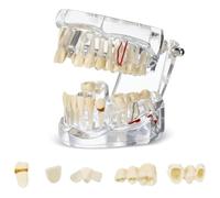 Willoghsa Modèle dentaire maladique, implant dentaire typodonte avec dents amovibles, démonstration dentaire standard pour dentiste