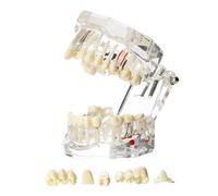 Windplusya Modèle de dents de maladie transparent avec pont d'implant dentaire, modèle amovible pour enseignement dentaire, modèle de dent pour l'éducation des patients et des étudiants dentaires