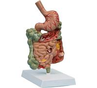 WLGDBXF Modèle de système digestif pathologique, modèle d'organe du Gros intestin grêle, modèle d'anatomie de l'estomac Humain pour l'enseignement aux étudiants