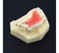 WOTZOV Modèle pédagogique, modèle de Contention Dentaire, modèle d'étude pour l'éducation du Patient, Outils pédagogiques pour la démonstration orthodontique.