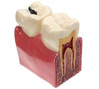 WOTZOV Modèle pédagogique, Modèle de dent cariée, Modèle de dent Malade pour l'éducation du Patient, Modèle d'étude Comparative de la Carie (6 Niveaux), Outils pédagog