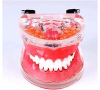WOTZOV Modèle pédagogique, Modèle Dentaire pour l'étude des Dents atteintes de parodontite - Modèle de dent de démonstration pour l'éducation du Patient