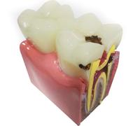 Wudaizhi Modèle De Dents De Dents De Caries - 6X Modèle D'éducation À L'anatomie Agrandie pour Les Outils D'enseignement, Étude De Comparaison Bilatérale, Démonstration en Coupe Transversale