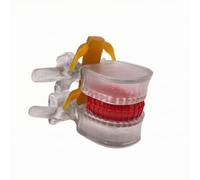 Xgdsnly Modèle Prolapsus Discal Interactif | Conception Agrandie, Modèle Prolapsus discal Discale Lombaire, Éducatif, pr Laboratoire D'anatomie, Orthopédistes